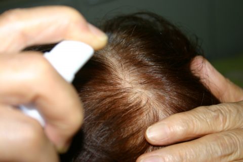 外用薬は初期脱毛が起こりにくい？初期脱毛がおこりにくい治療法は？