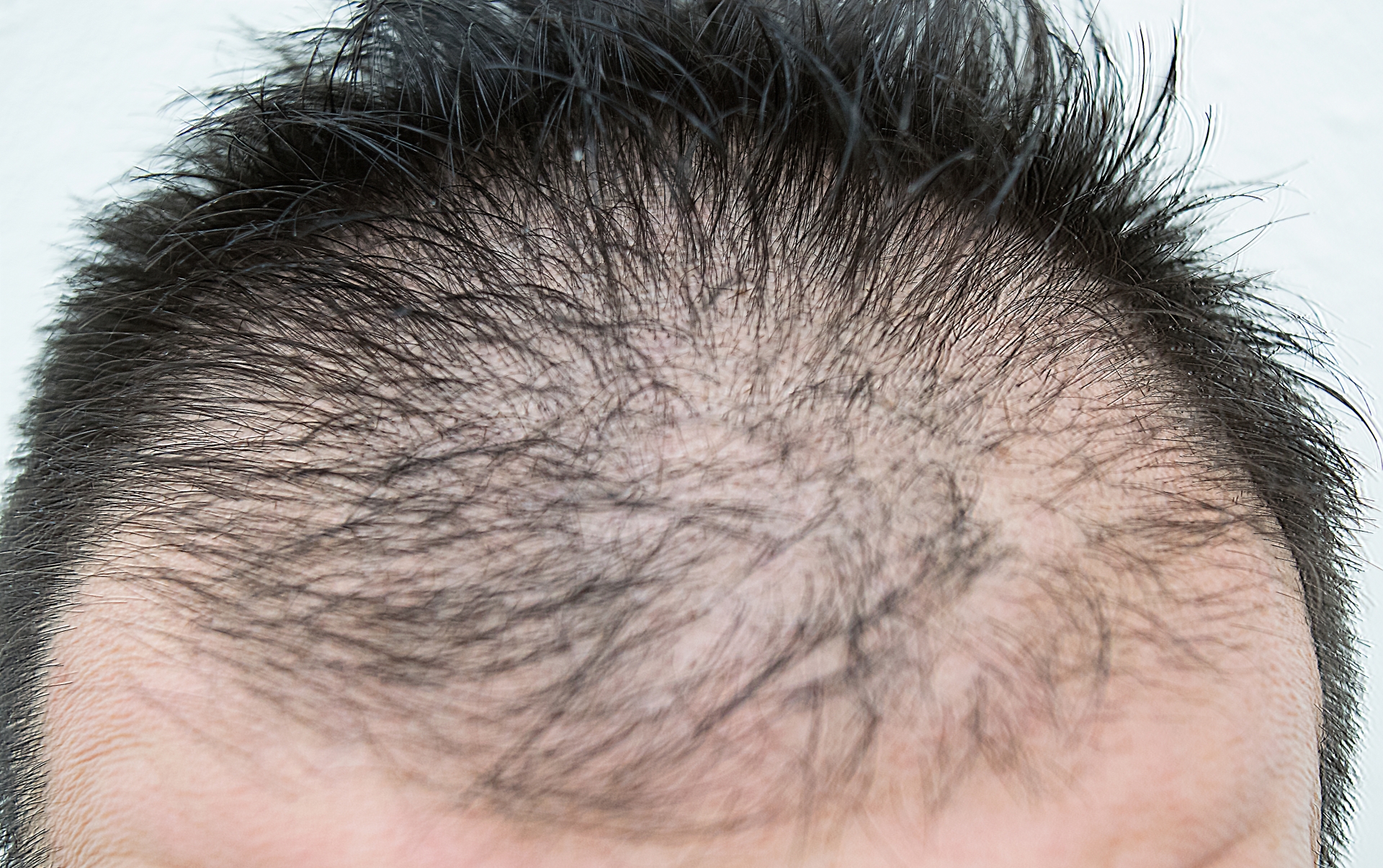 AGA（男性型脱毛症）とは？他の脱毛症（ハゲ）との違いは？