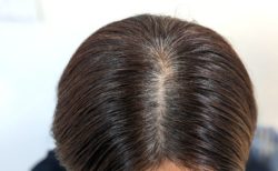 分け目と薄毛の関係性は？「髪の分け目部分」に薄毛が発症するケースもあるって本当？